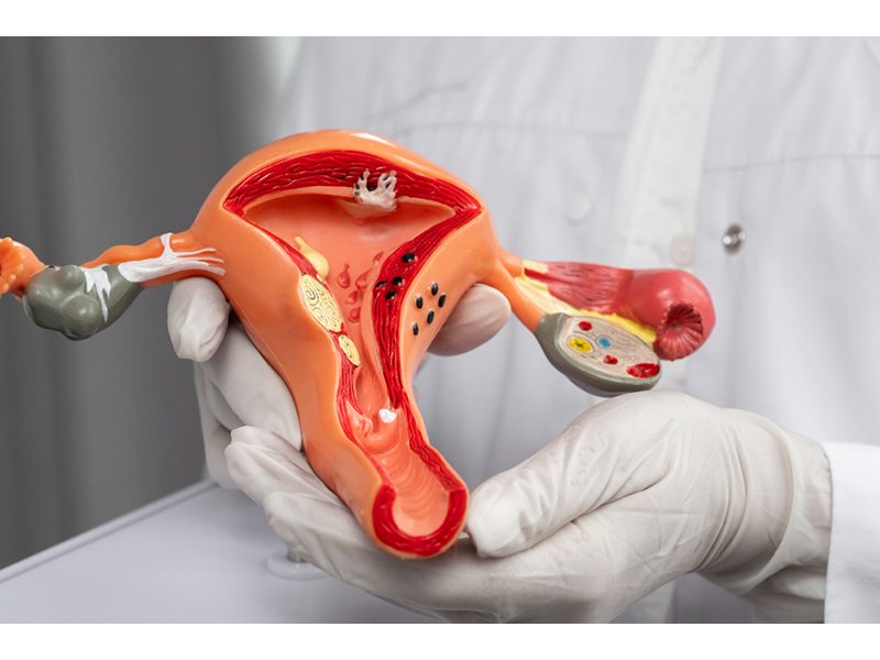 Ankara Miyom Tedavisi